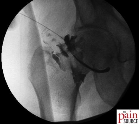 Corticosteroid Hip Injection under Fluoroscopy - Courtesy Dr. Hazem Eissa 