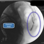 Ganglion Impar block - marked up Ganglion Impar Block under fluoroscopy