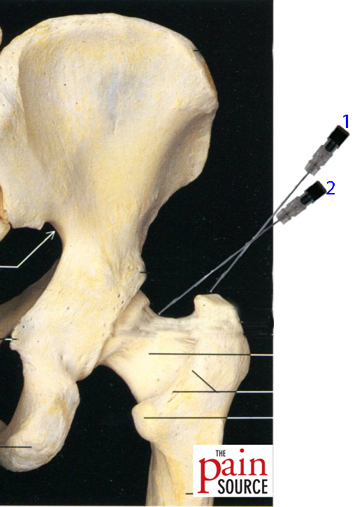 Procedure: Intraarticular Hip Injection Under Fluoroscopy