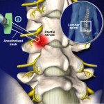 Medial Branch Block SpineSurgeon.co.uk