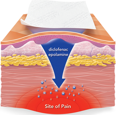 Epidural steroid injection site pain