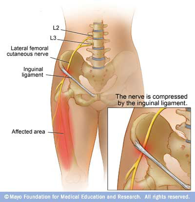 Epidural steroid injection in lumbar spine