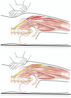 Steroid injection site pain