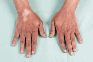 Steroid injection in wrist side effects
