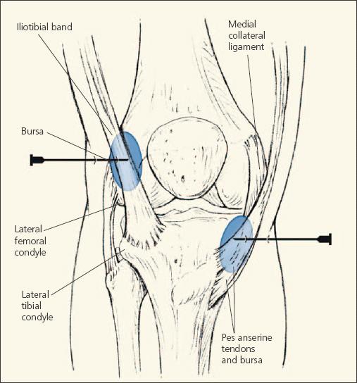 Pes Bursitis