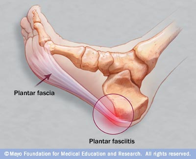 Steroid injection foot plantar fasciitis