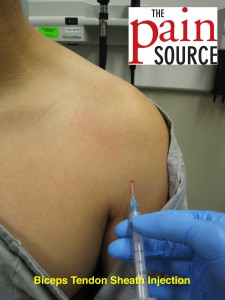 Pes anserine bursitis steroid injection