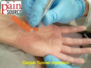 Steroid injections for carpal tunnel syndrome