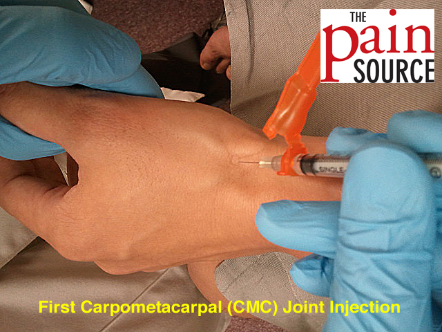 Plantar Fasciitis Injection