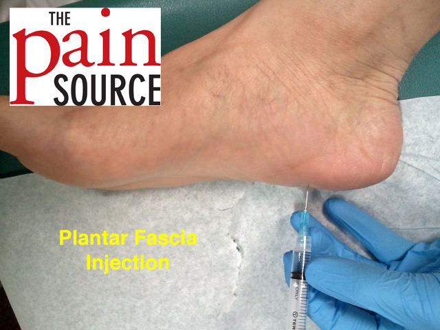 cortisone for plantar fasciitis