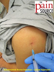 Intra articular steroid injection risks