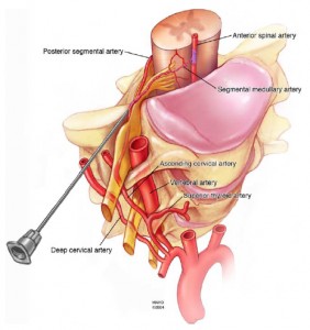 Safe epidural steroid injections
