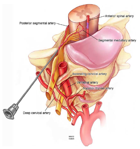 Epidural steroid block cpt code