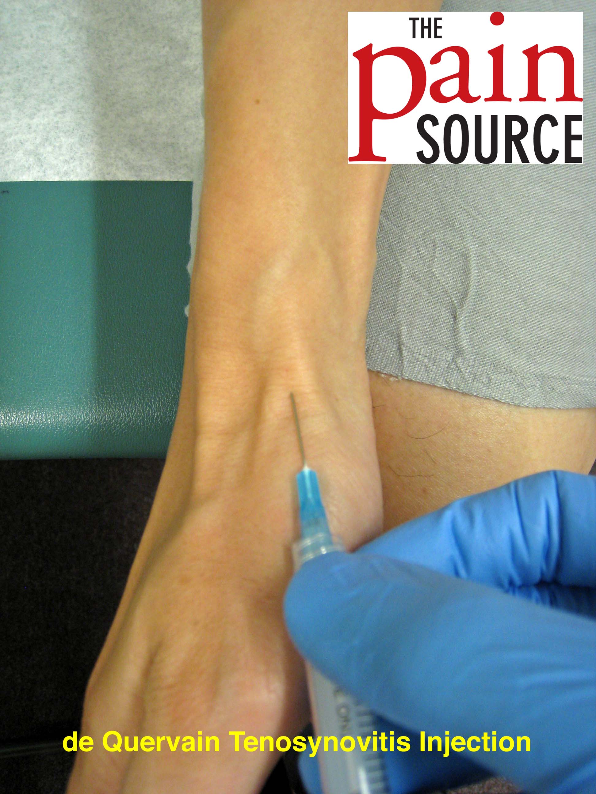 kenalog injection for de quervain tenosynovitis)