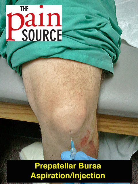 knee effusion treatment