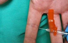 Carpometacarpal joint steroid injection
