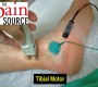 Stimulate 8-cm proximal to E1 (curved line around medial malleolus)