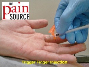 Plantar fasciitis steroid injection technique