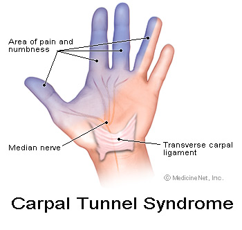 is the emg test for carpal tunnel painful