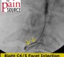 VIDEO:  Cervical Facet Injection