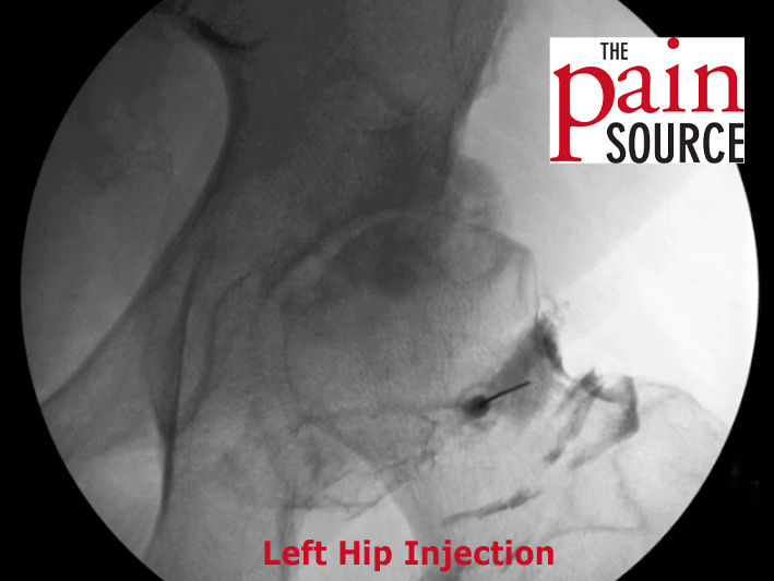 hip injection