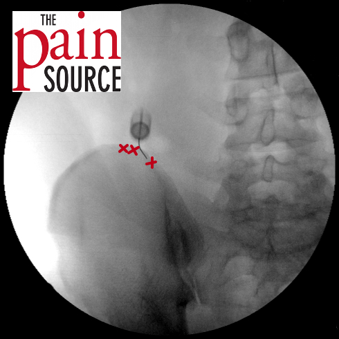 Iliolumbar ligament steroid injection