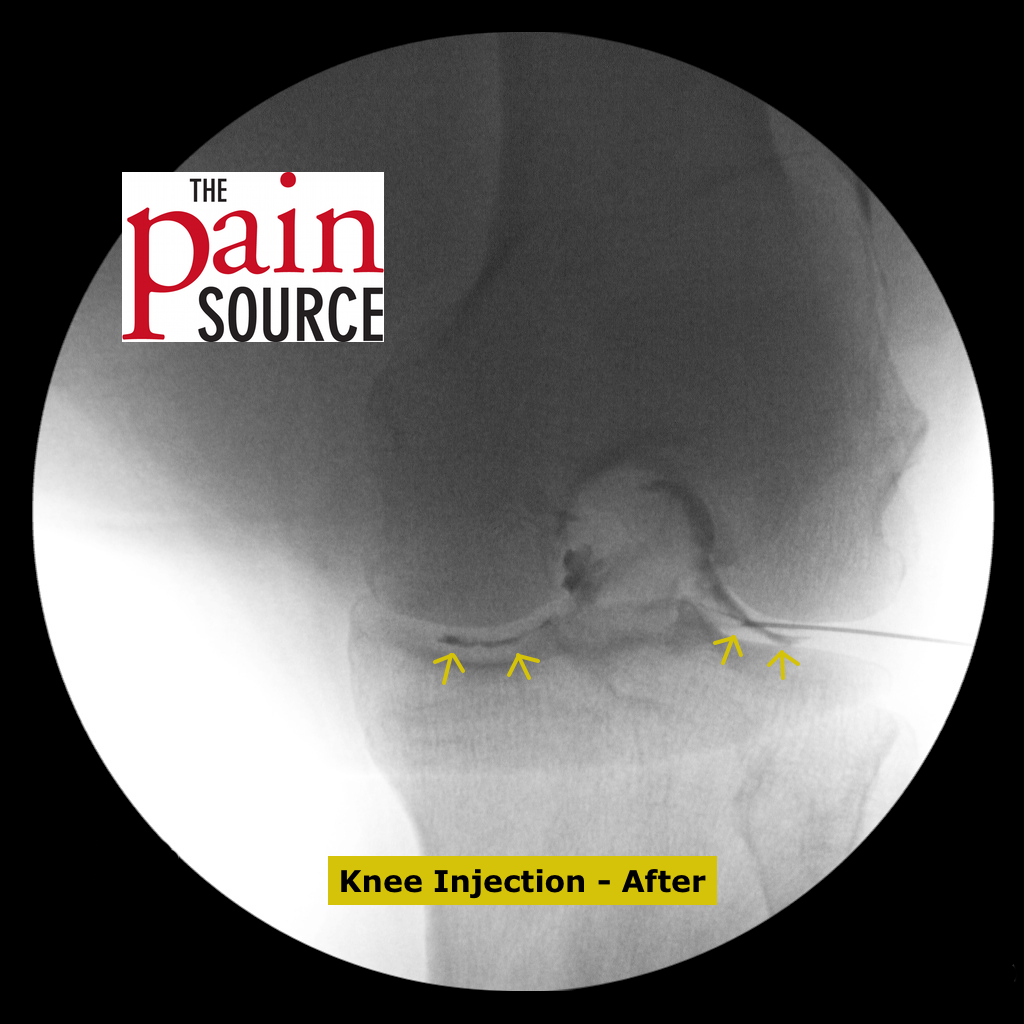 Interventional Procedures Archives - The Pain Source