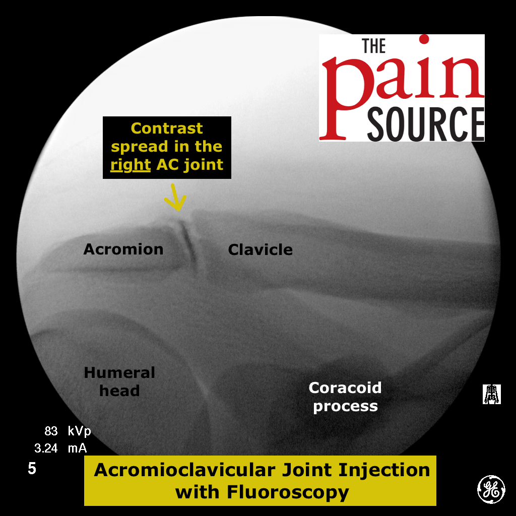 Acromioclavicular Joint Injection With Fluoroscopy The Pain Source