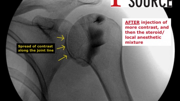 Final image. After injection of the steroid and local anesthetic mixture. Note the intraarticular spread. Also note that no contrast is seen under the acromion process, which means there is not likely a full thickness rotator cuff tear.
