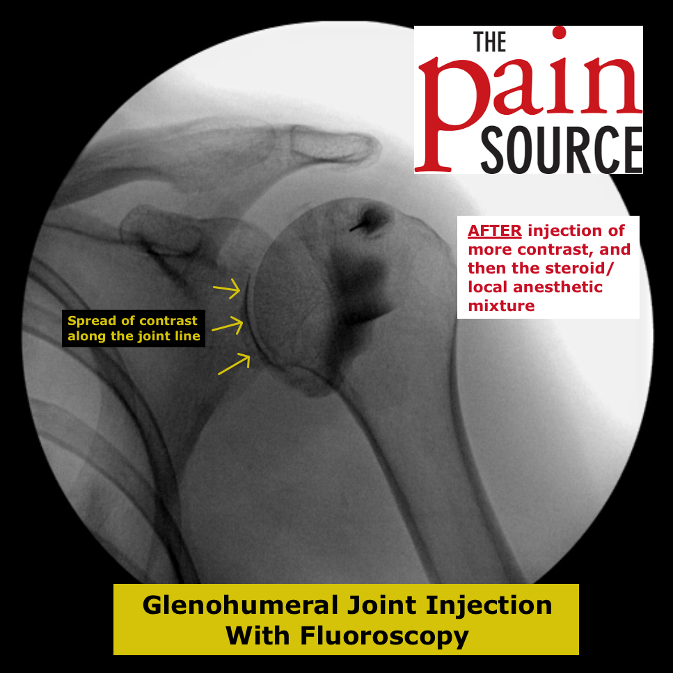 Icd 9 Procedure Code For Epidural Steroid Injection