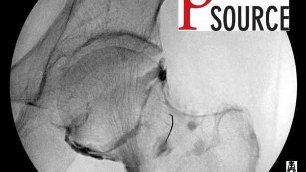 Note above that the contrast has been diluted and spread out more after the corticosteroid and local anesthetic was injected.