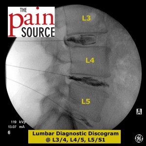 Lumbar epidural steroid injection painful