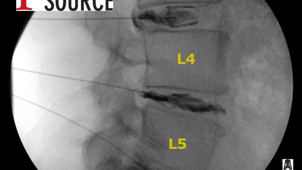 Lumbar Discography
