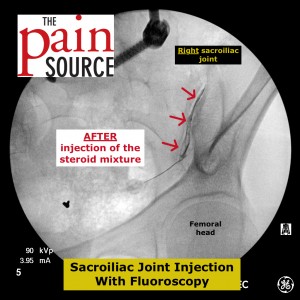 Steroid injection site pain relief