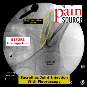 Sacroiliac joint steroid injection video