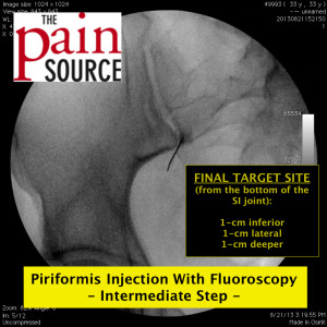 Shoulder steroid injection procedure note