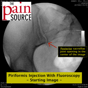 Steroid injection for si joint pain