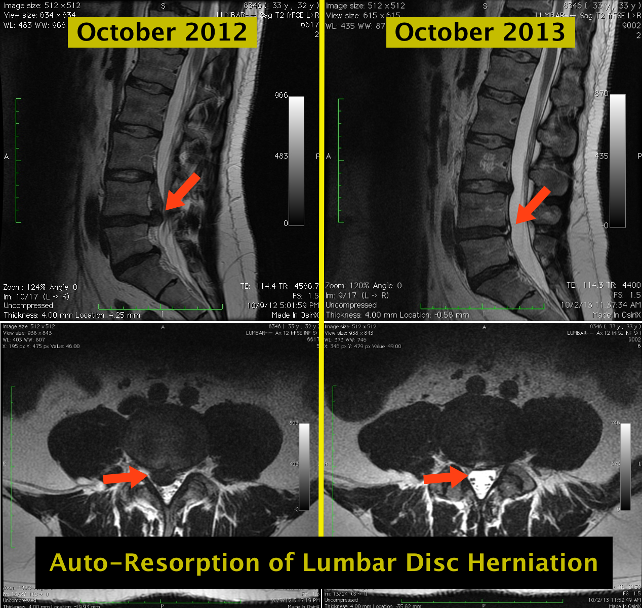 Auto Resorption Of Lumbar Disc Herniation The Pain Source Makes Learning About Pain Painless