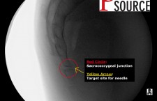 Ganglion impar block – Labeled start of procedure – The Pain Source