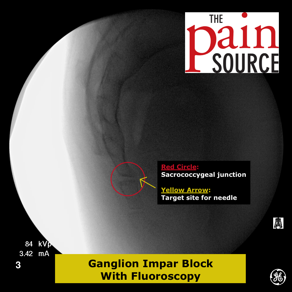 Ganglion impar block Labeled start of procedure The Pain Source