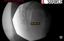 Ganglion impar block – Needle to anterior of sacrum – The Pain Source