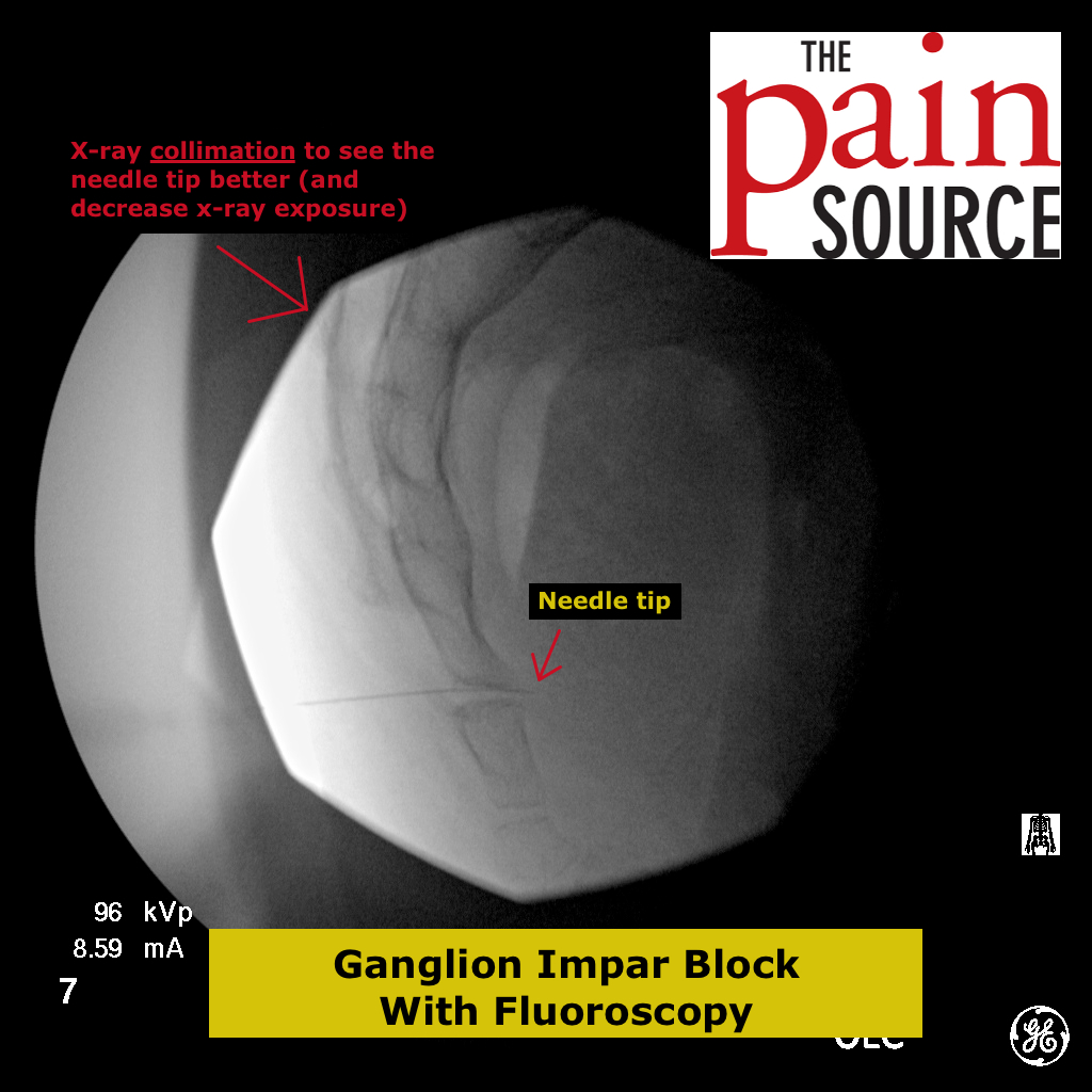 Ganglion Impar Block with Fluoroscopy The Pain Source Makes