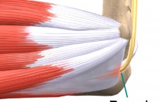 Ulnar entrapment at elbow