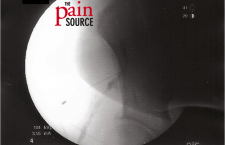 Lateral femoral cutaneous nerve block