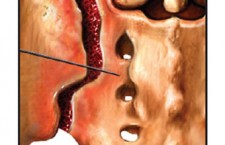 Sacroiliac Joint Injection