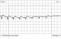 severe pain after emg test