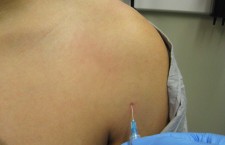 Biceps Tendon Sheath Injection
