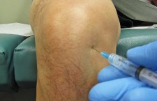 Knee Joint Steroid Injection – alternate view