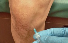 Knee Joint Steroid Injection