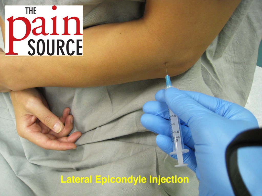 Lateral Epicondyle Injection – Technique and Tips - The Pain Source ...